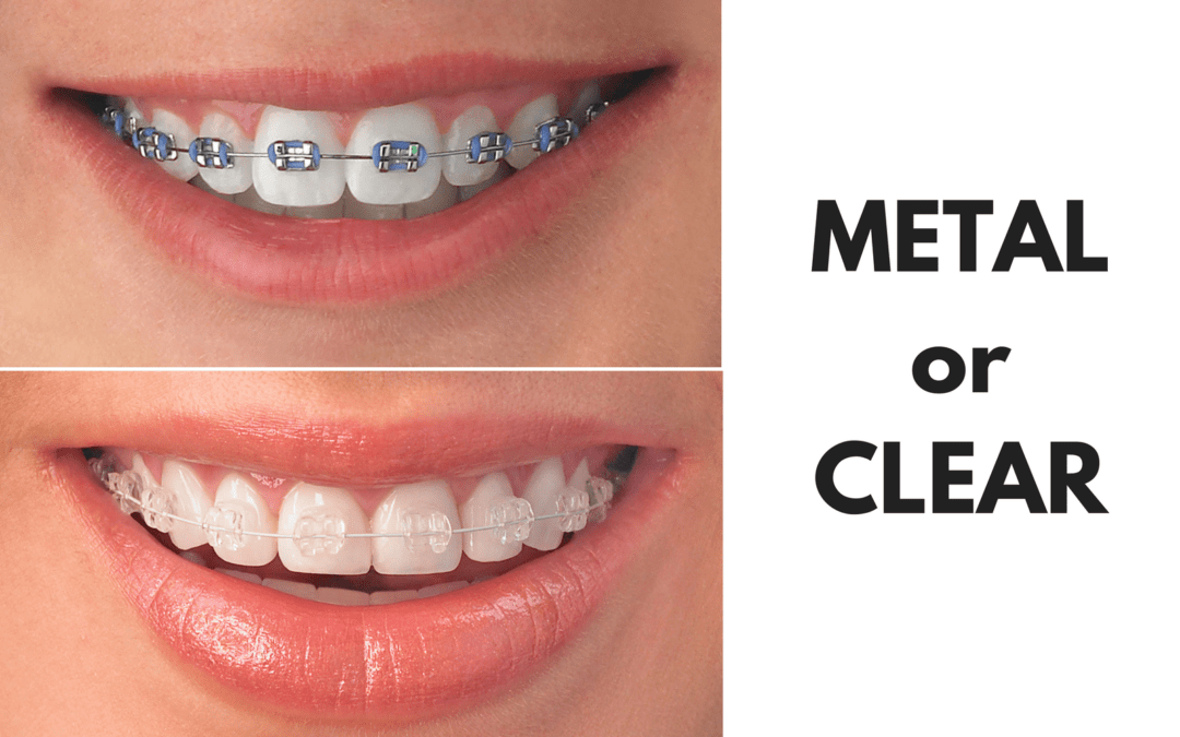 Ask Your Austin or Georgetown Dentist: Should I Get Metal or Clear Braces?