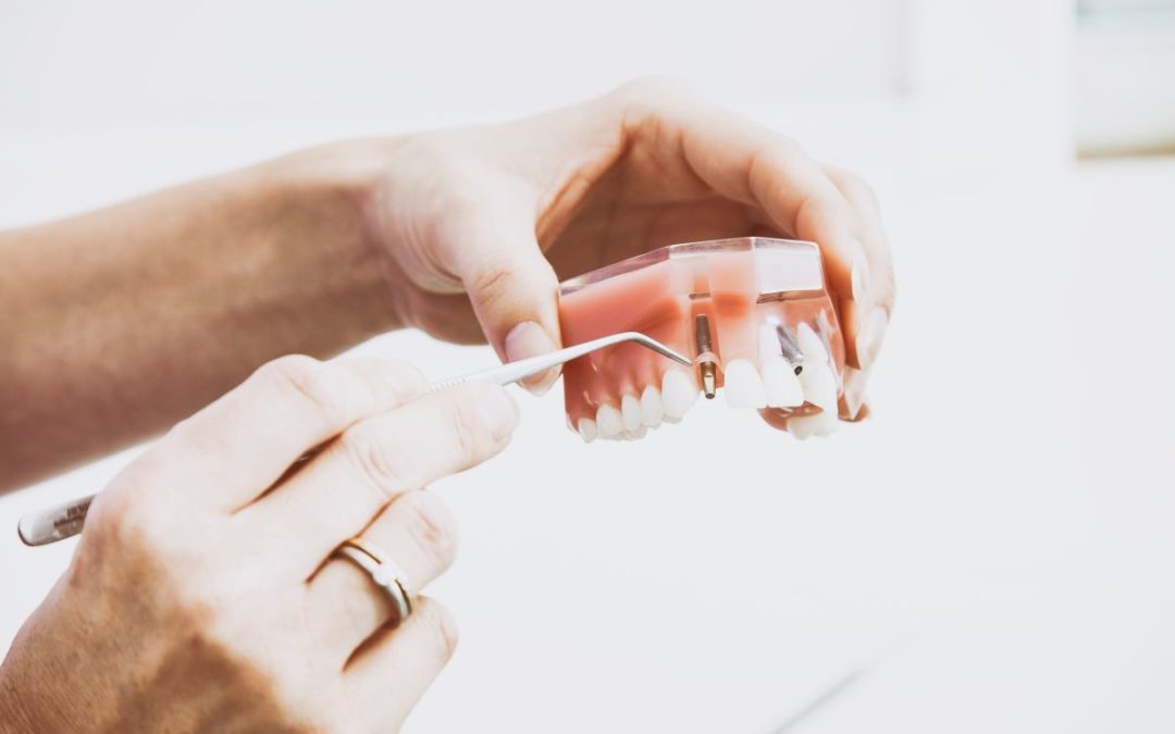 Dental Implant Recovery – Facts You Need to Know