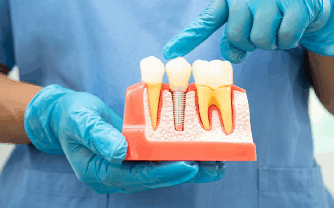 Can You Get Dental Implants After Tooth Loss? Here’s What to Know