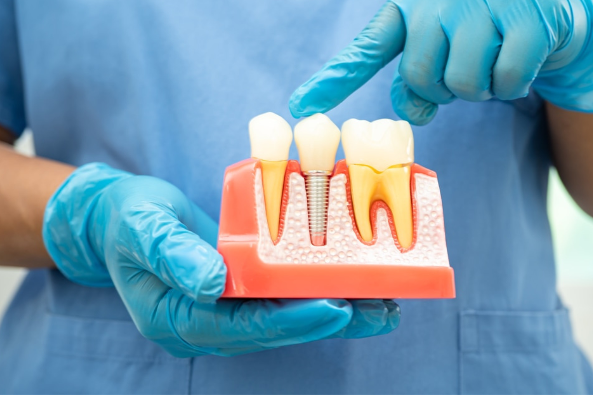dental implant austin (1) Can You Get Dental Implants After Tooth Loss? Here’s What to Know