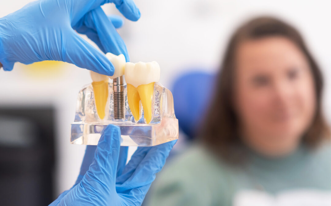 How Long Does a Dental Implant Procedure Take?