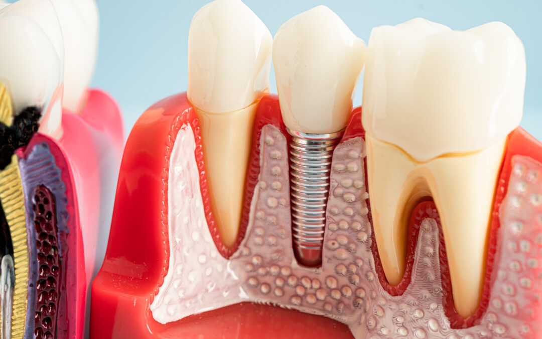 What Happens if Food Gets Stuck Under Your Dental Implants?
