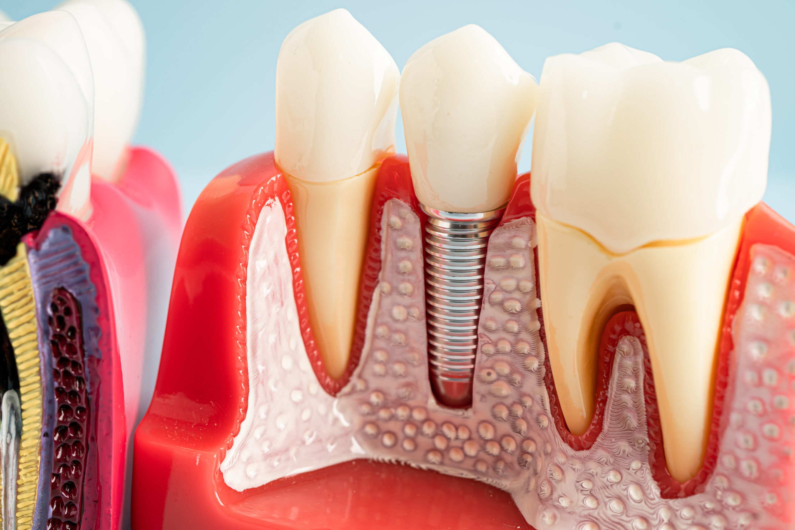 What Happens if Food Gets Stuck Under Your Dental Implants?