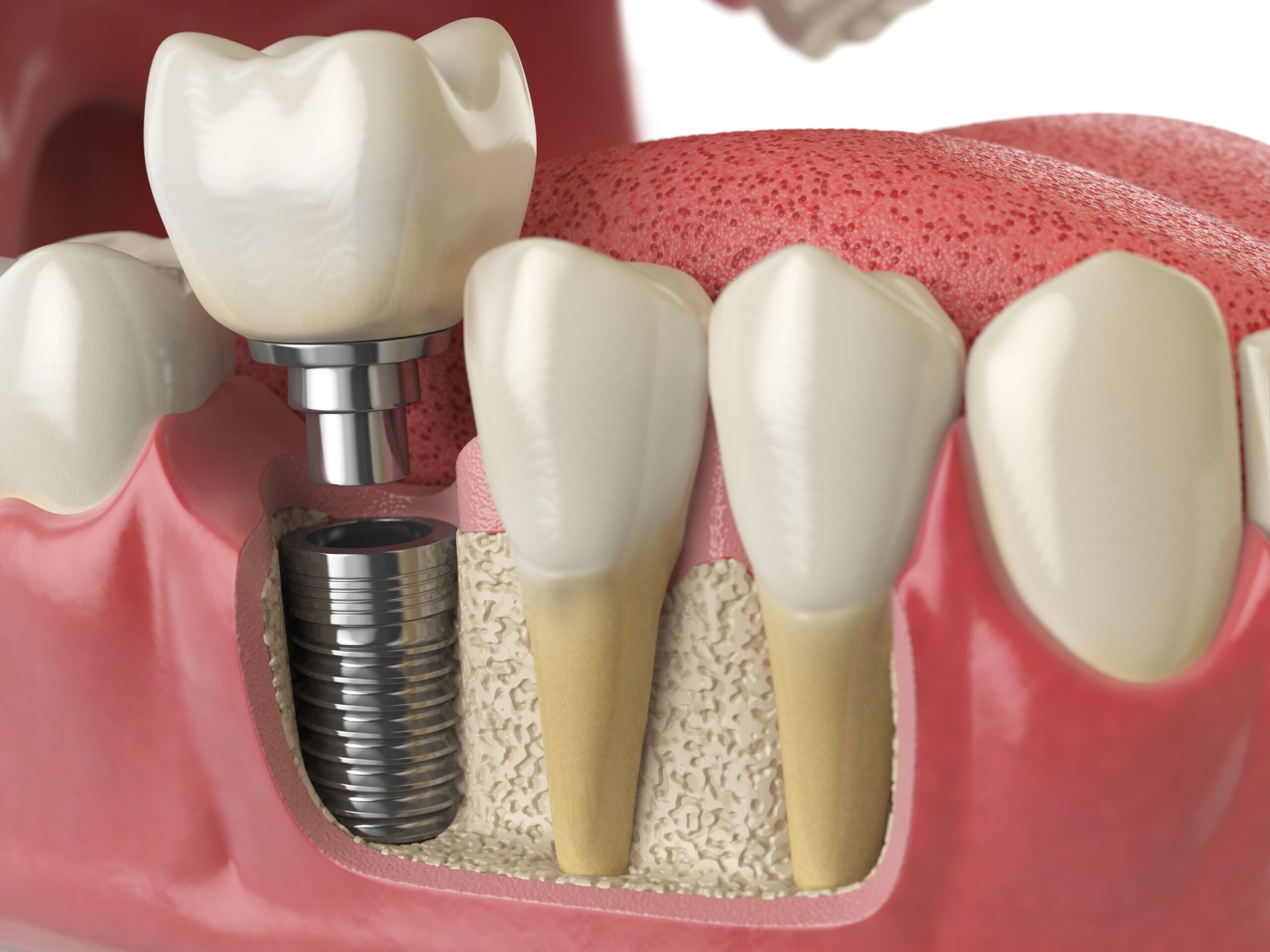 How to Care for Your Dental Implants