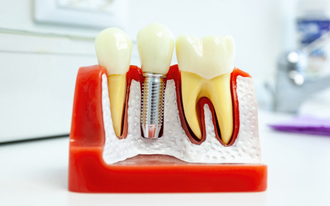 Are Dental Implants Safe and Long-Lasting?