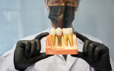 How Long After Dental Implants Can I Talk Normally?