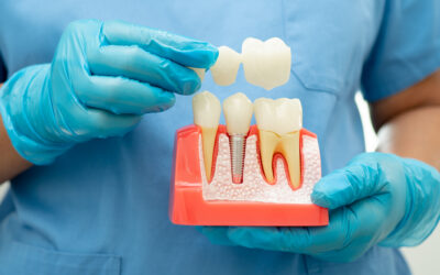 Can a Dental Implant Get a Cavity?