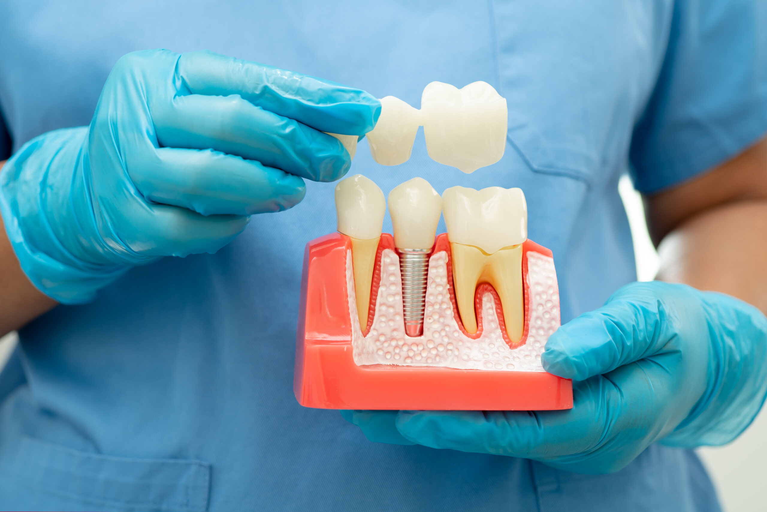 Can Dental Implants Get Cavities