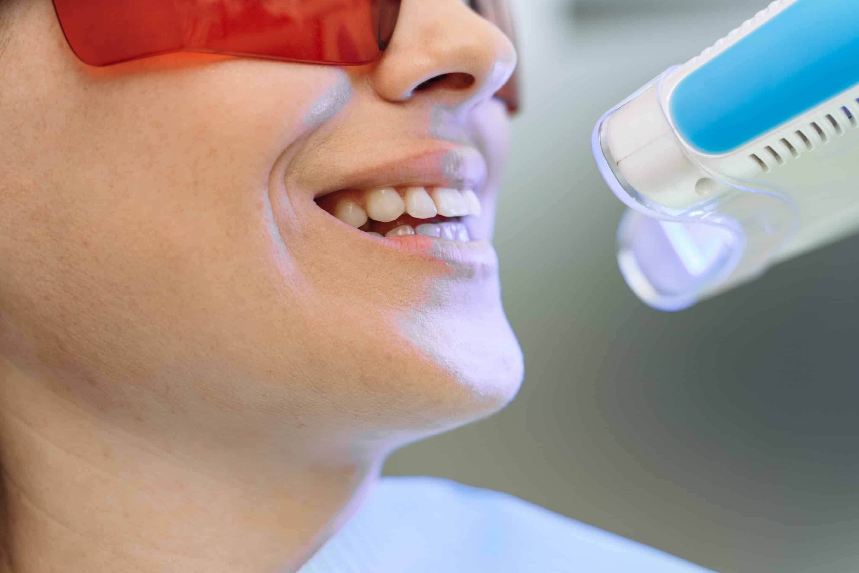 Patient receiving professional teeth whitening treatment to avoid common teeth whitening mistakes and achieve a brighter, healthier smile.