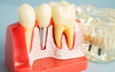 Dental Implants: What Nobody Tells You Before Treatment