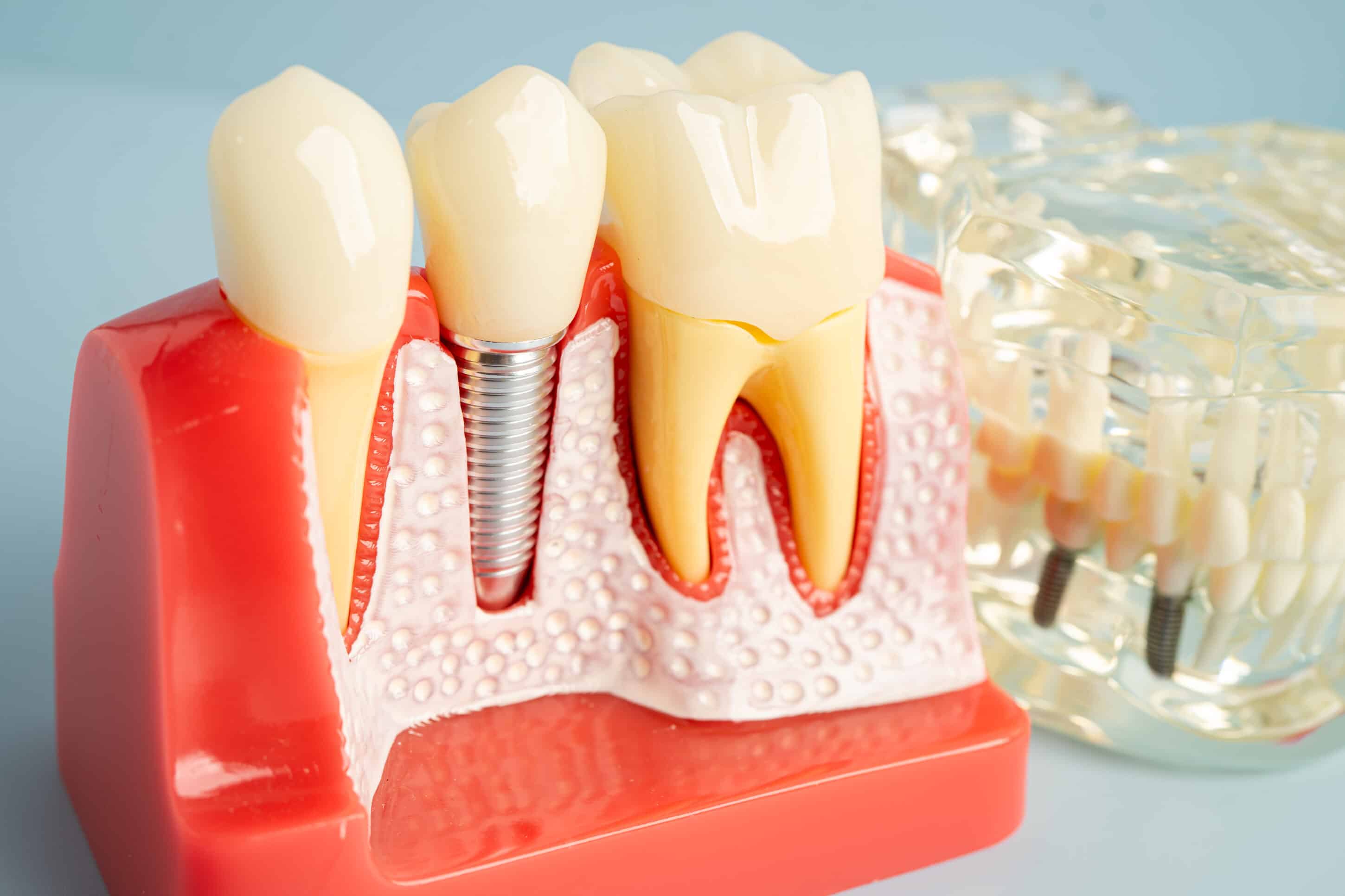 Dental Implants: What Nobody Tells You